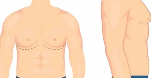 গাইনিকোম্যাস্টিয়া: পুরুষের স্তন বৃদ্ধির কারণ ও চিকিৎসা