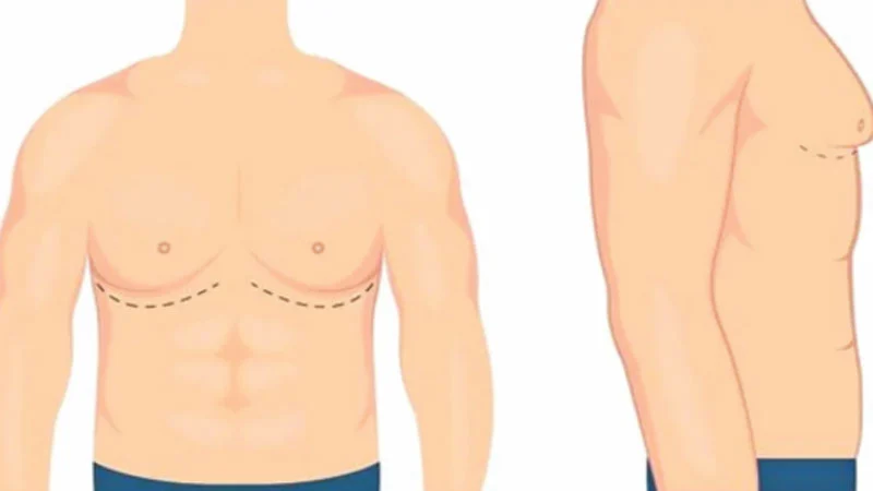 গাইনিকোম্যাস্টিয়া: পুরুষের স্তন বৃদ্ধির কারণ ও চিকিৎসা