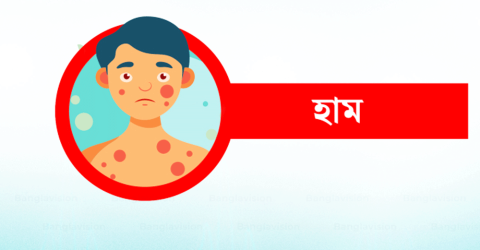 ২৪ ঘণ্টায় হাম উপসর্গে ৬ মৃত্যু, নতুন রোগী ১,০৭৪