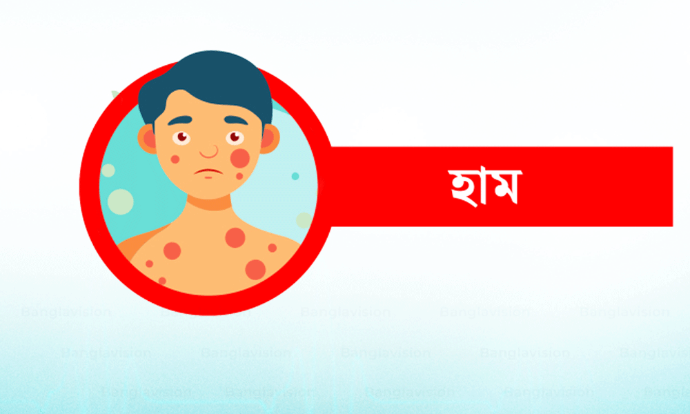 ২৪ ঘণ্টায় হাম উপসর্গে ৬ মৃত্যু, নতুন রোগী ১,০৭৪