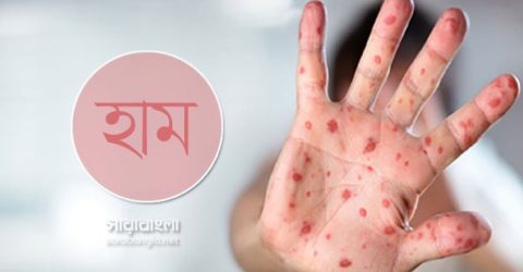 এক দিনে হামের উপসর্গে আক্রান্ত আরও ১,০৩১ শিশু