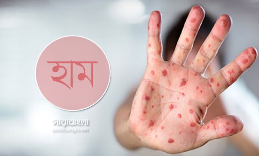 এক দিনে হামের উপসর্গে আক্রান্ত আরও ১,০৩১ শিশু